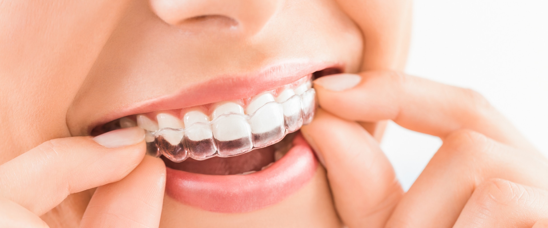 Where to Get Invisalign: Find an Expert Near You
