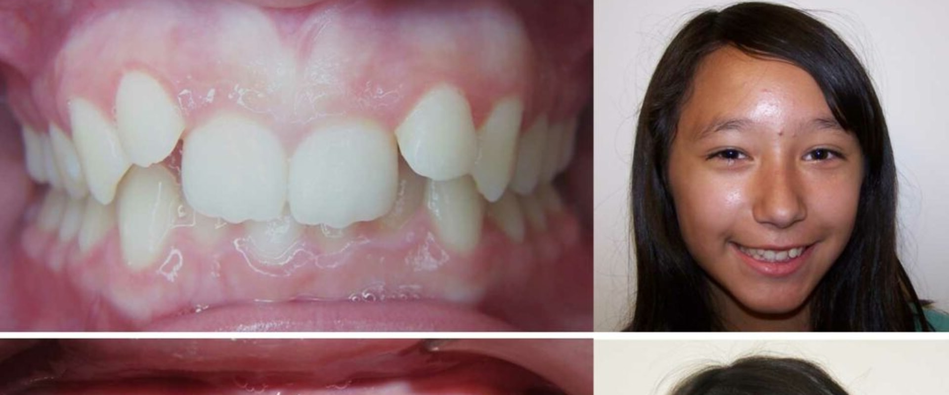 How does invisalign correct overbite?