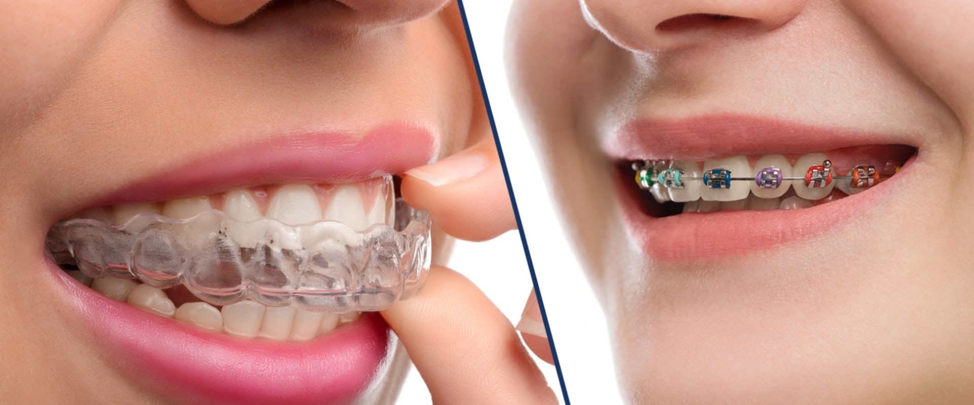 Is Invisalign or Braces More Effective for Straightening Teeth?