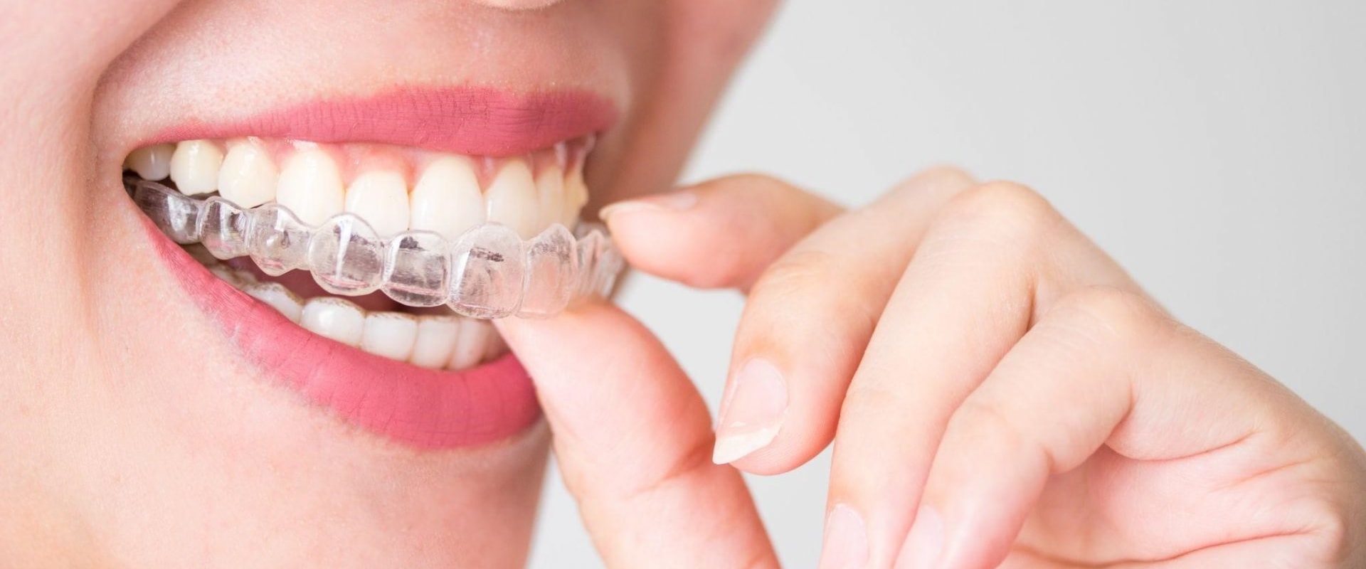 Why Invisalign Accessories are a Must for Your Orthodontic Treatment