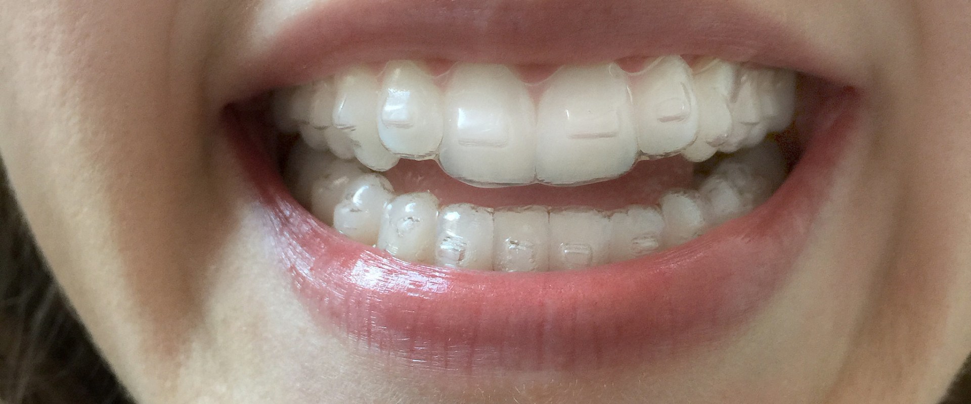 What are the disadvantages of invisalign?