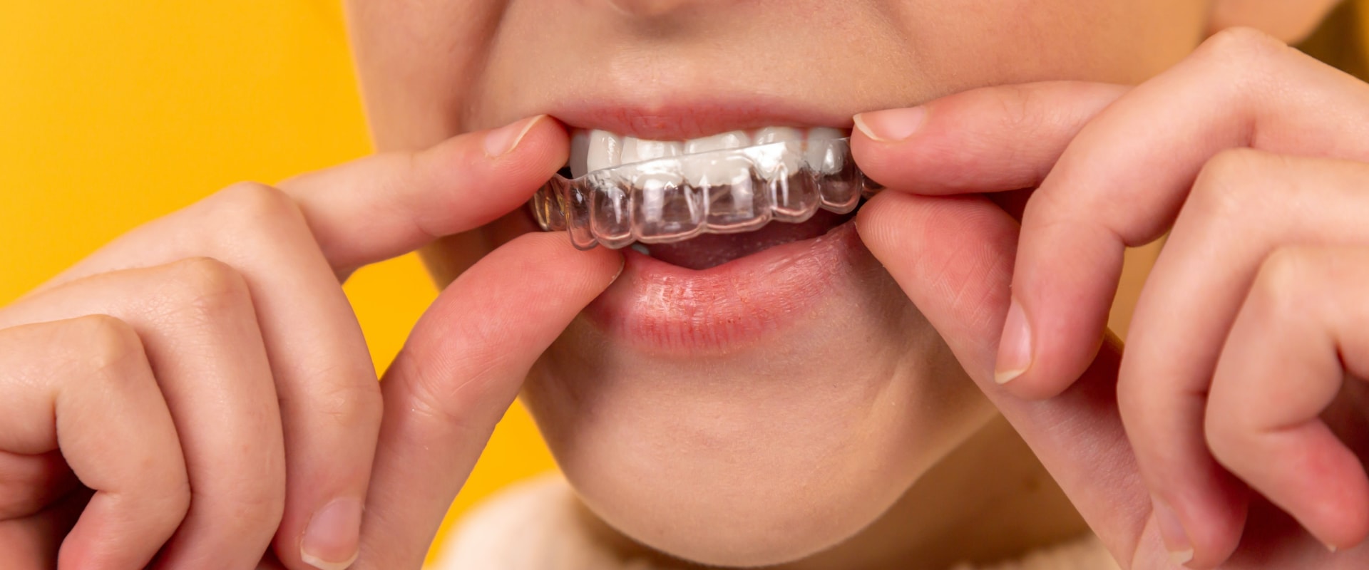 Is Invisalign Worth the Price Tag of $6000?