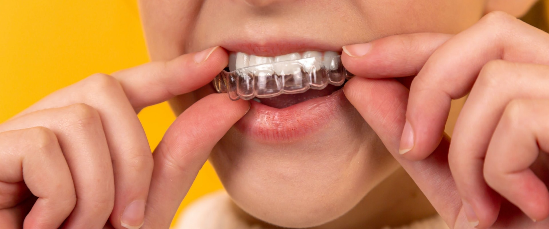 Do Dentists Make Money with Invisalign?