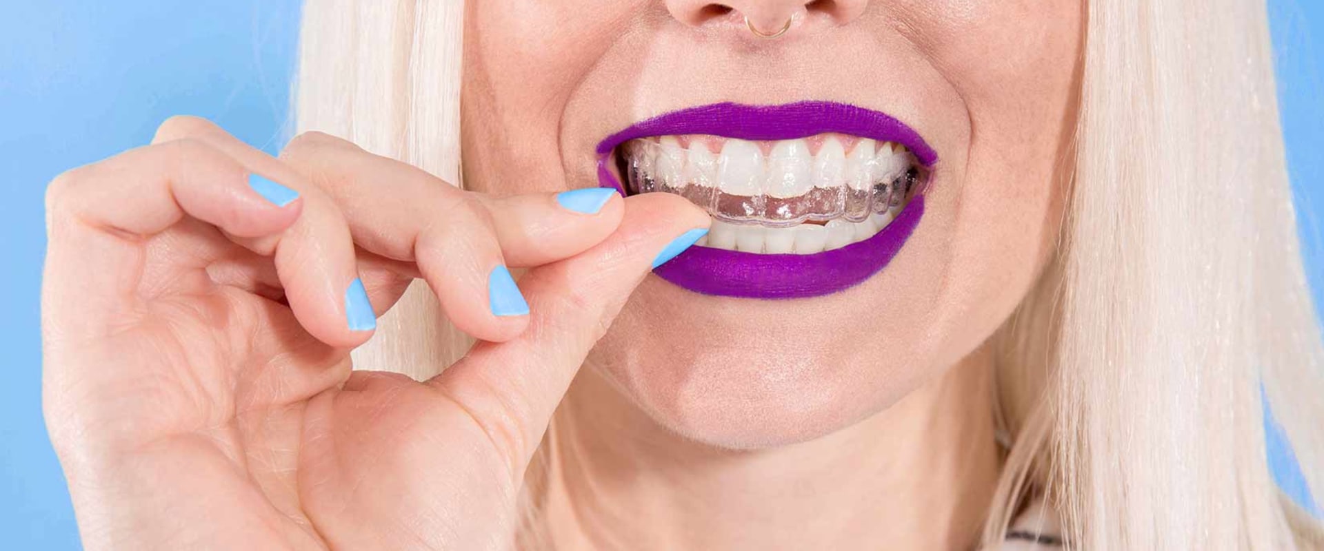Who Owns Invisalign? Align Technology Explained