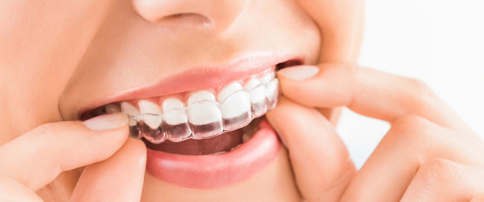 How Long Does It Take to Get Invisalign?