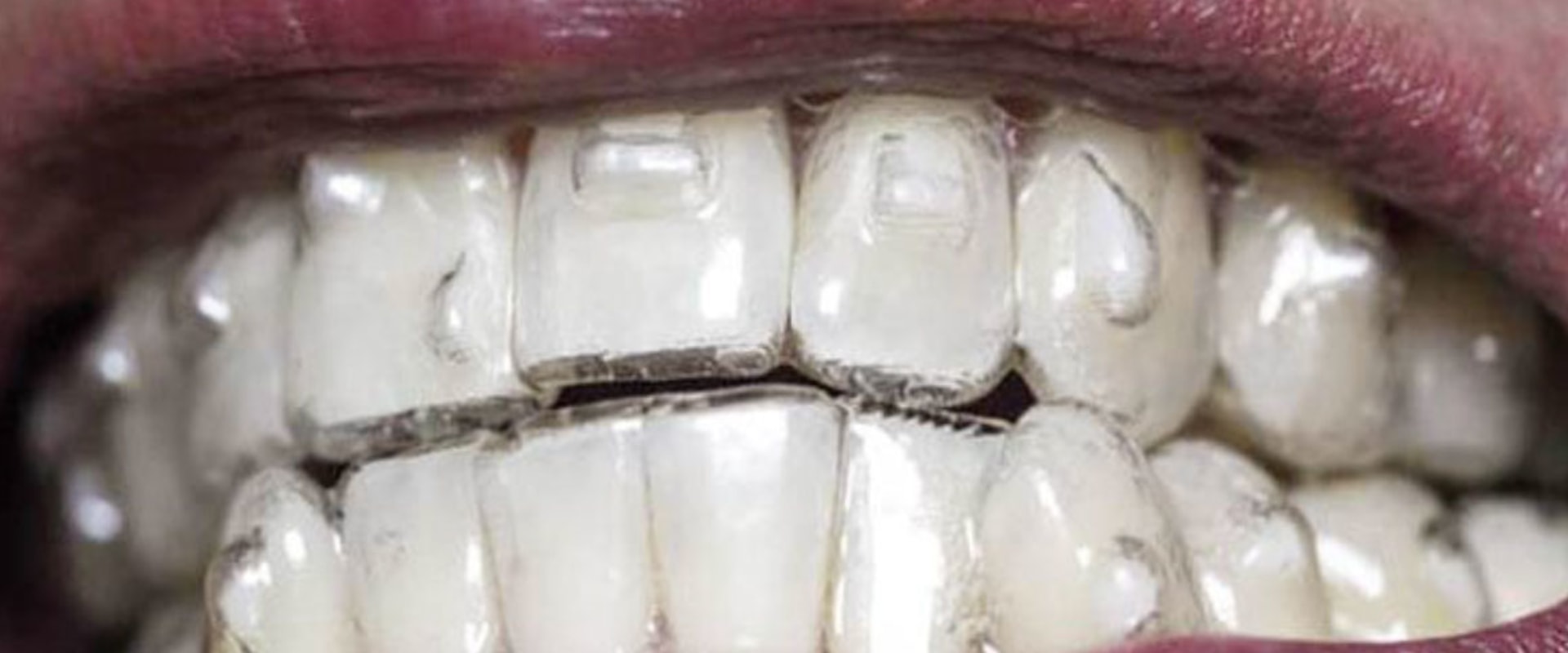 What Are Invisalign Attachments and How Do They Help Straighten Teeth?