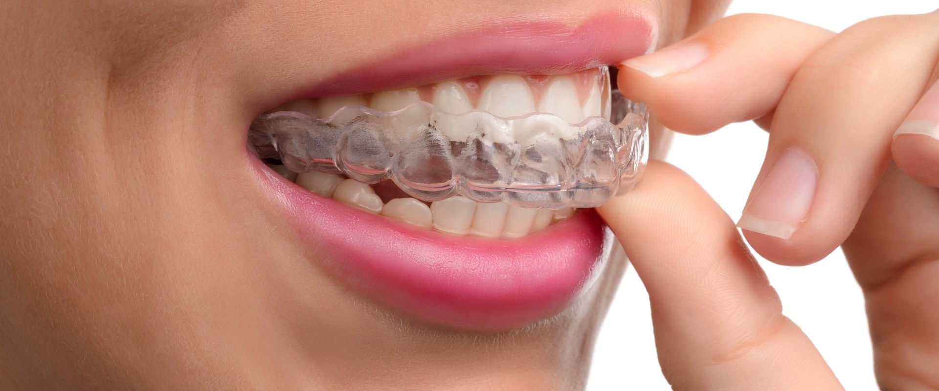 Can Invisalign Cause Permanent Damage?