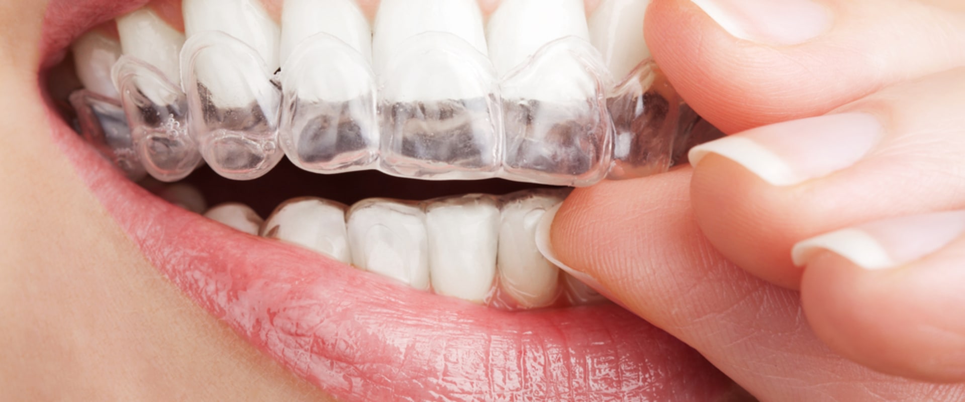 Who Can Benefit from Invisalign Orthodontic Aligners?
