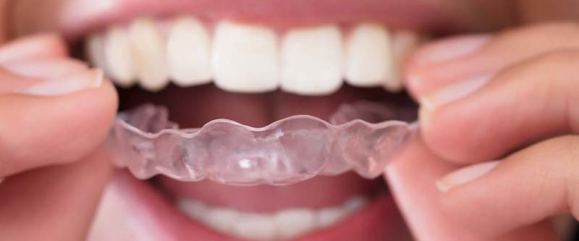 The Final Stage of Invisalign: Retainers and Maintenance