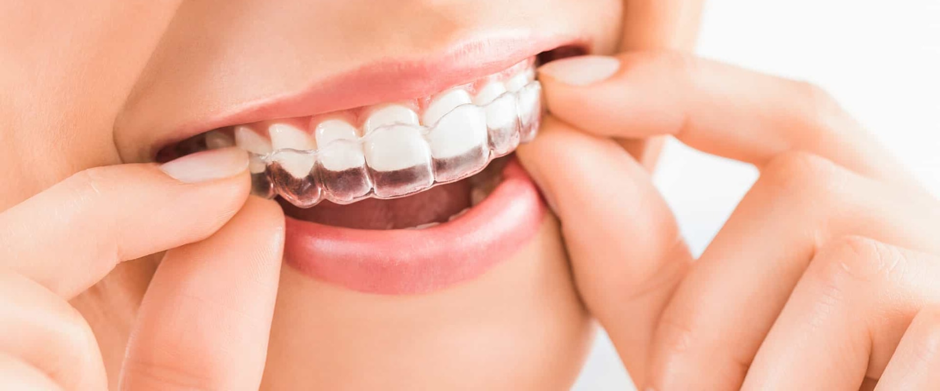 The Benefits of Invisalign Braces for Oral Hygiene