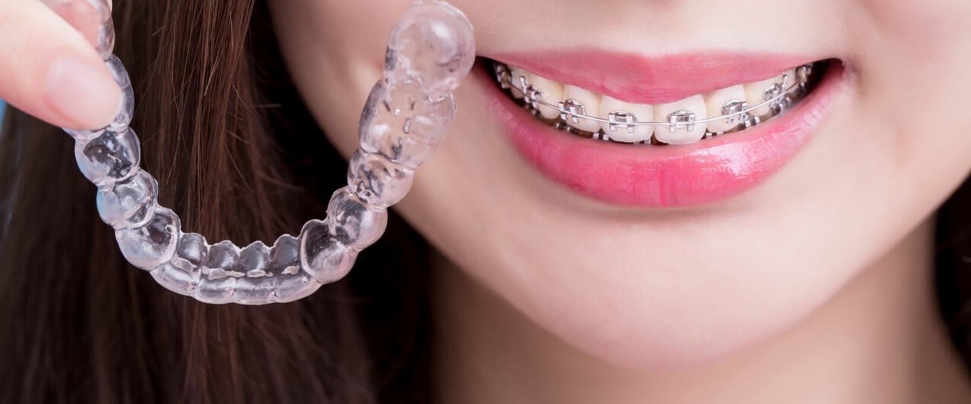 Invisalign which is better?