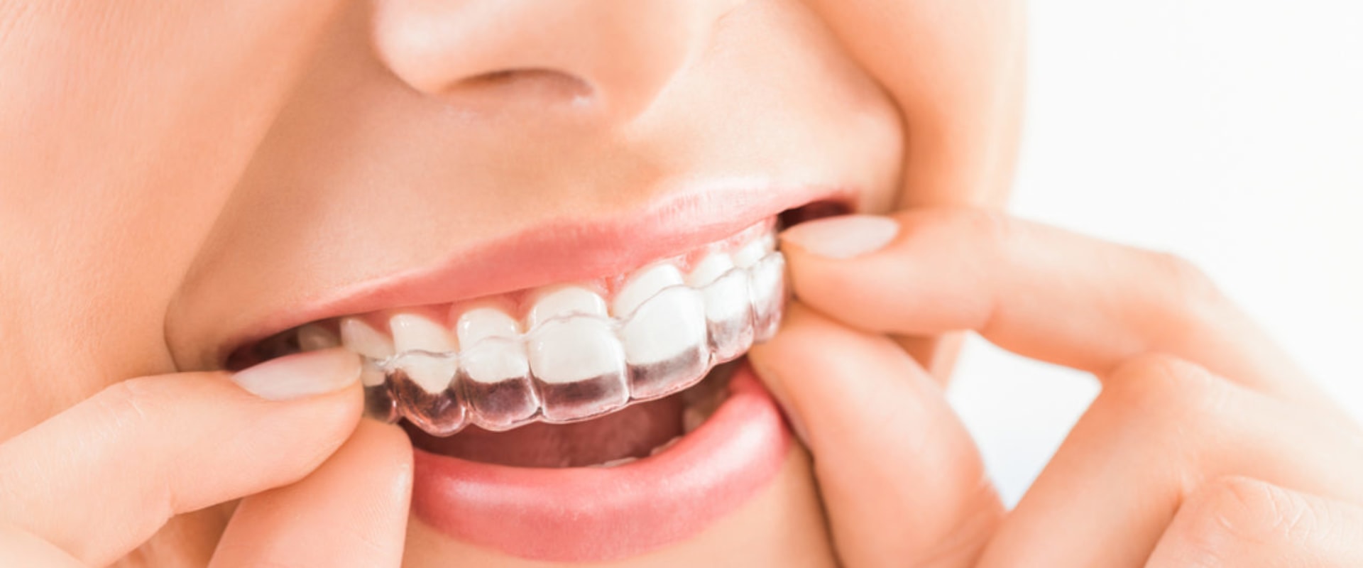 Invisalign: What Teeth Move First and How to Speed Up the Process