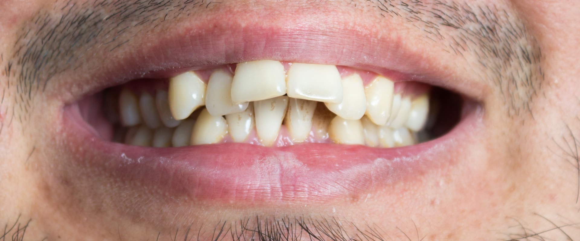Who Can't Benefit from Invisalign Treatment?