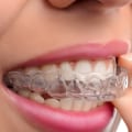 Is Invisalign or Braces More Effective for Straightening Teeth?