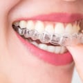 Why Invisalign Accessories are a Must for Your Orthodontic Treatment