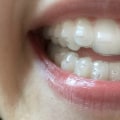 What are the disadvantages of invisalign?