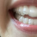 What are the disadvantages of invisalign?
