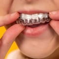 Is $6000 too much for invisalign?