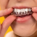 Do Dentists Make Money with Invisalign?