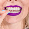 Which company owns invisalign?