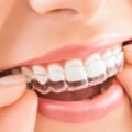 How long does it take to make invisalign?