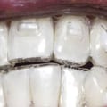 What Are Invisalign Attachments and How Do They Help Straighten Teeth?