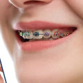Which is easier braces or invisalign?
