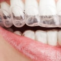Who Can Benefit from Invisalign Orthodontic Aligners?