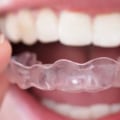 The Final Stage of Invisalign: Retainers and Maintenance
