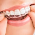 Why is invisalign faster than braces?
