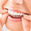 The Benefits of Invisalign Braces for Oral Hygiene