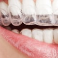 Can you be denied invisalign?