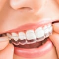 Invisalign: What Teeth Move First and How to Speed Up the Process