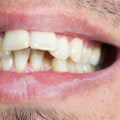 Who is invisalign not suitable for?