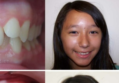 How Invisalign Can Correct Overbite