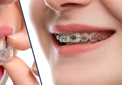 Is Invisalign or Braces More Effective for Straightening Teeth?