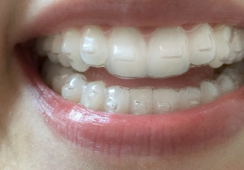 What are the disadvantages of invisalign?