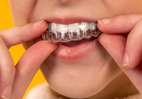 Is $6000 too much for invisalign?