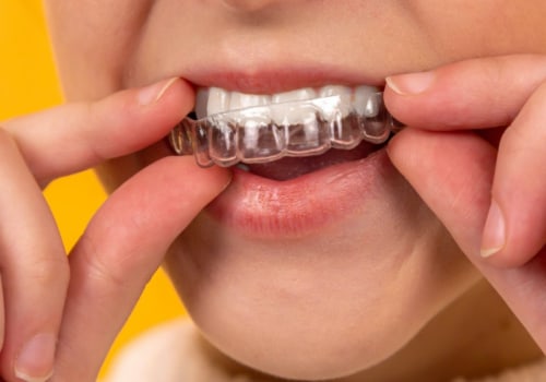Do Dentists Make Money with Invisalign?