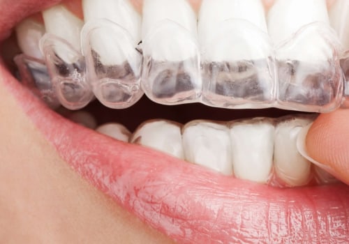 When does invisalign not fit?