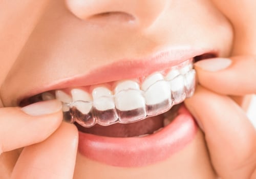 How Long Does It Take to Get Invisalign?
