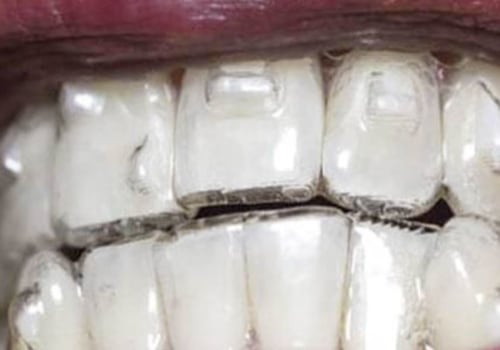 What Are Invisalign Attachments and How Do They Help Straighten Teeth?