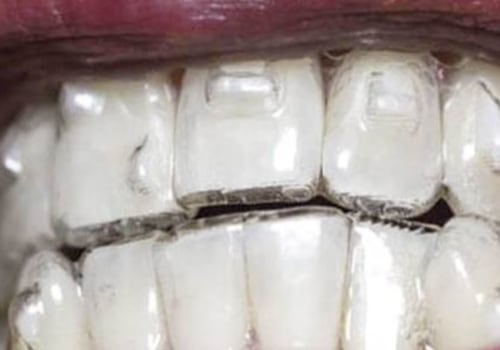 Invisalign which teeth need attachments?