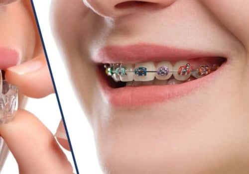 Which is Easier: Braces or Invisalign?