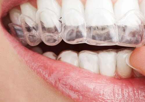 Who Can Benefit from Invisalign Orthodontic Aligners?