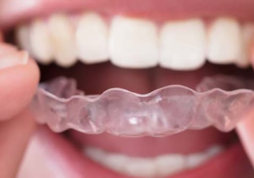 What is the last stage of invisalign?