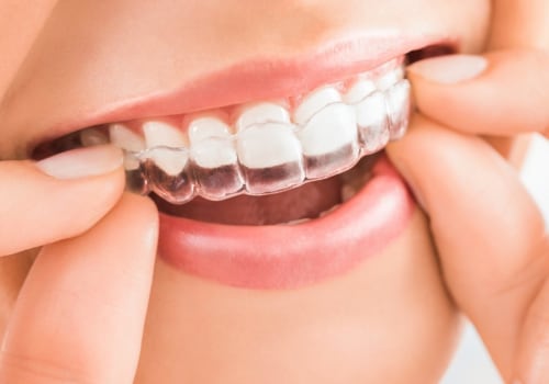 Why Invisalign is Faster Than Braces: A Comprehensive Guide