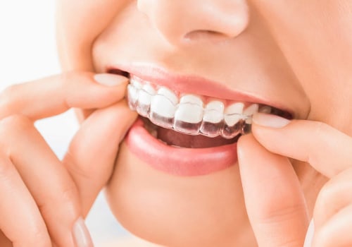 The Benefits of Invisalign Braces for Oral Hygiene