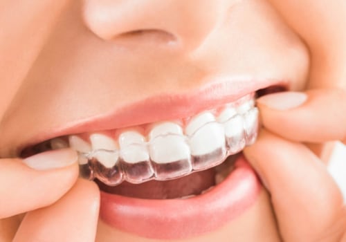 Invisalign which teeth move first?