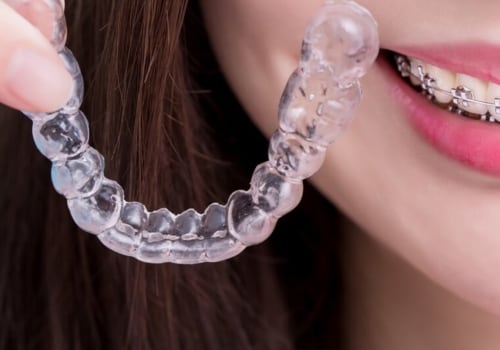 What is better invisalign or braces?